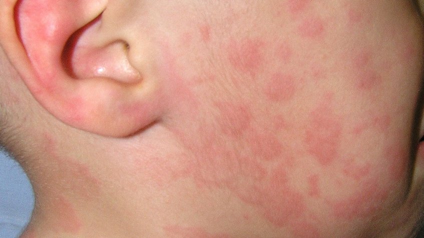 Urticaria aguda | Doctor Pedro Ernesto Vargas